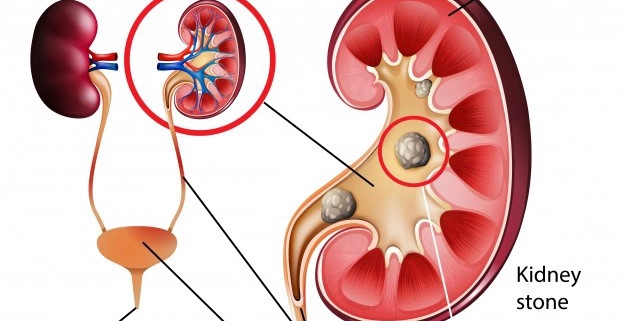 سنگ کلیه چیست؟ – آزمایشگاه پاتوبیولوژی توانا